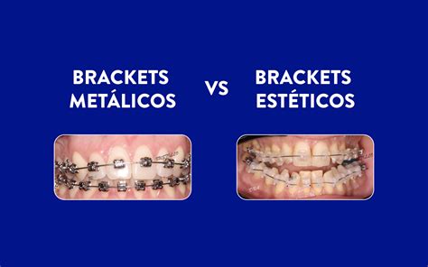 diferencias entre brackets metalicos y esteticos|Brackets estéticos vs metálicos: ¿Cuál es la mejor .